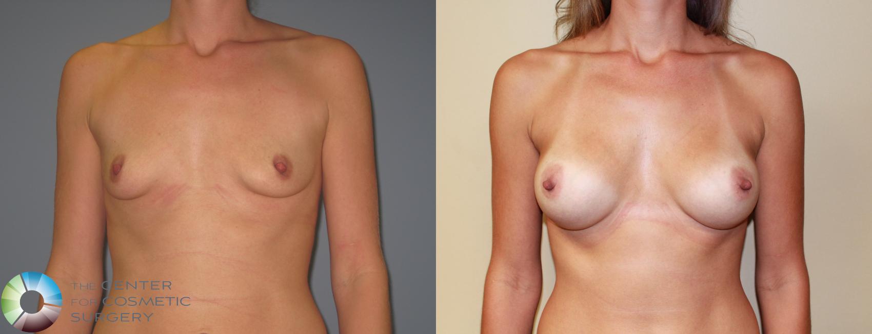 Before & After Breast Augmentation Case 11224 Front in Denver and Colorado Springs, CO