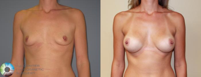 Before & After Breast Augmentation Case 11224 Front View in Golden, CO