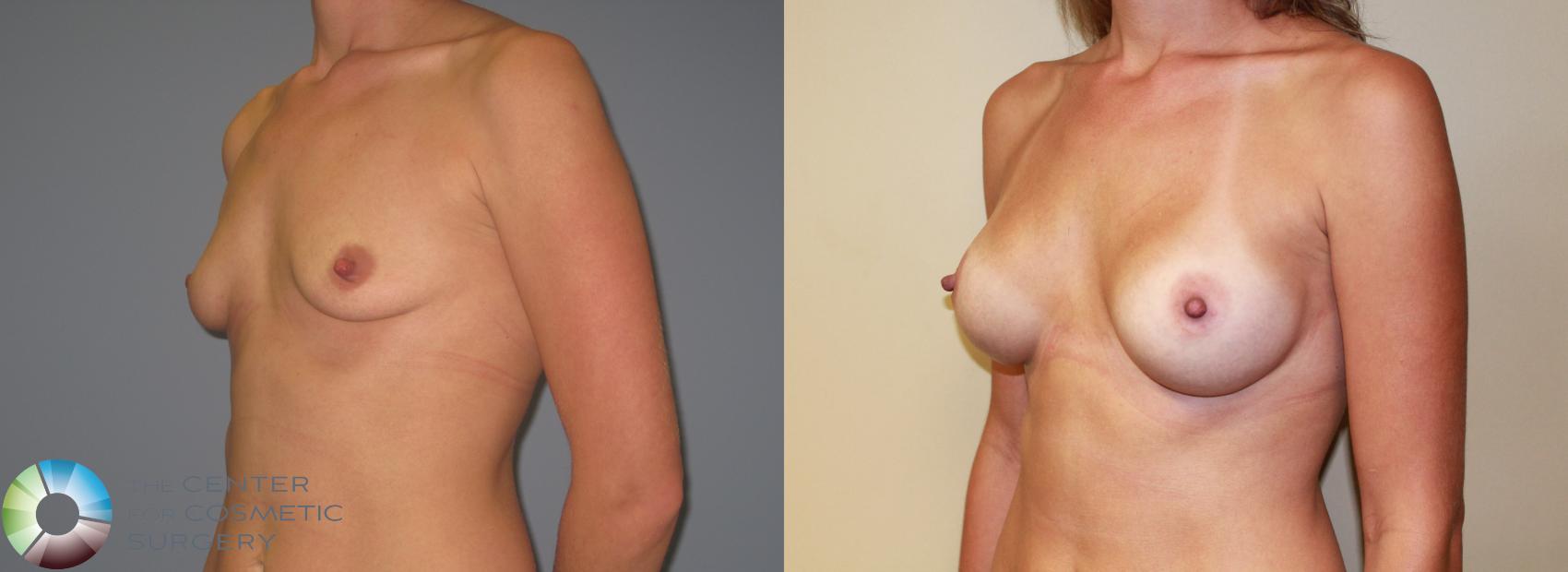 Before & After Breast Augmentation Case 11224 Left Oblique in Denver and Colorado Springs, CO