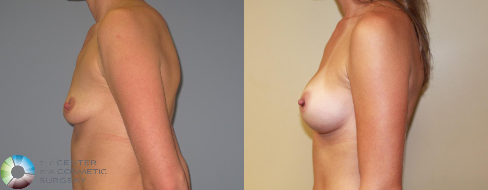 Before & After Breast Augmentation Case 11224 Left Side View in Golden, CO