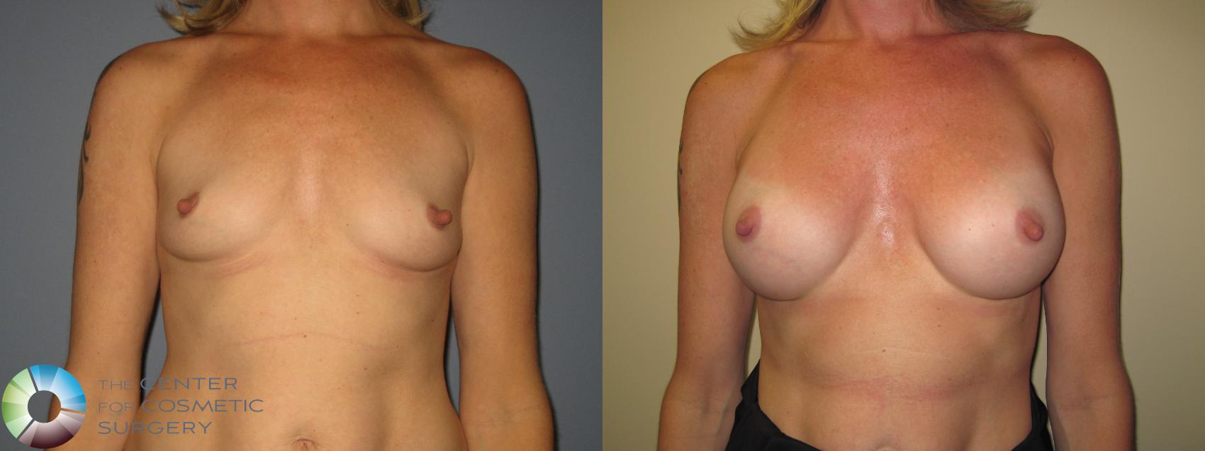 Before & After Breast Augmentation Case 11225 Front View in Golden, CO