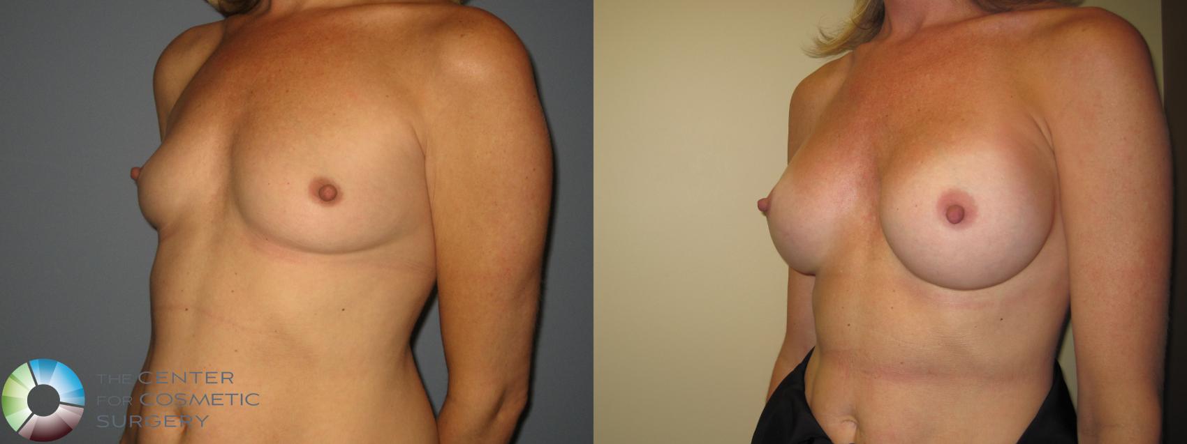 Before & After Breast Augmentation Case 11225 Left Oblique View in Golden, CO