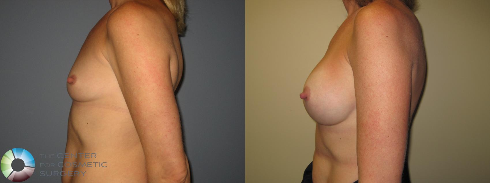 Before & After Breast Augmentation Case 11225 Left Side View in Golden, CO