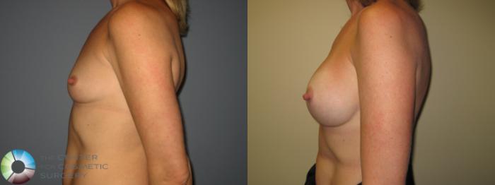 Before & After Breast Augmentation Case 11225 Left Side in Denver and Colorado Springs, CO