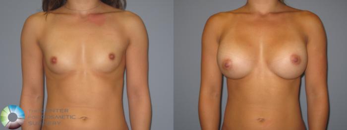 Before & After Breast Augmentation Case 11226 Front View in Golden, CO