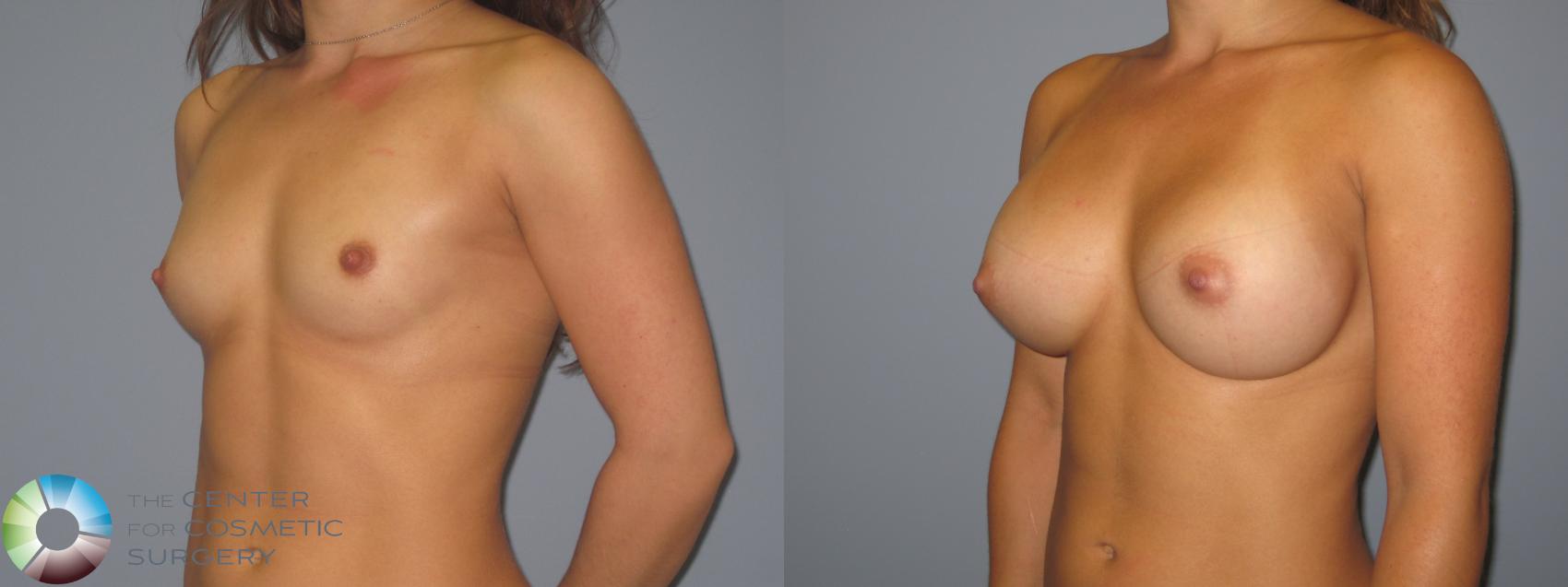 Before & After Breast Augmentation Case 11226 Left Oblique in Denver and Colorado Springs, CO