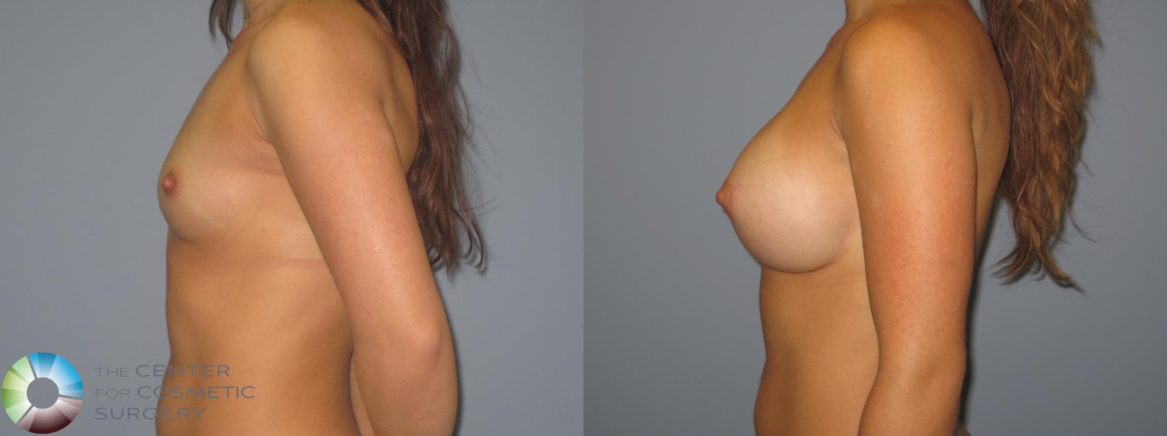 Before & After Breast Augmentation Case 11226 Left Side in Denver and Colorado Springs, CO