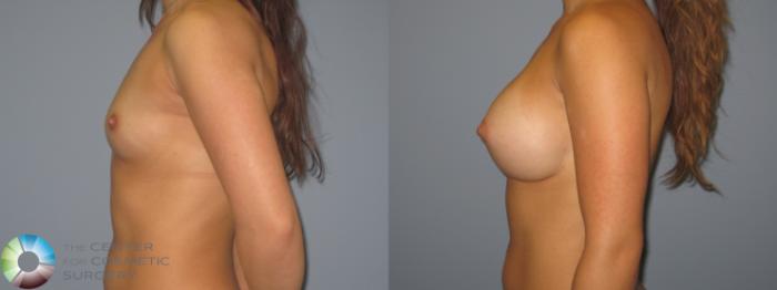 Before & After Breast Augmentation Case 11226 Left Side View in Golden, CO