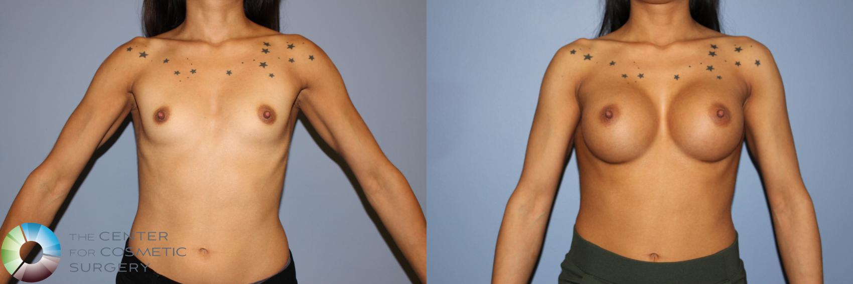 Before & After Breast Augmentation Case 11238 Front View in Golden, CO