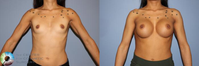 Before & After Breast Augmentation Case 11238 Front View in Golden, CO