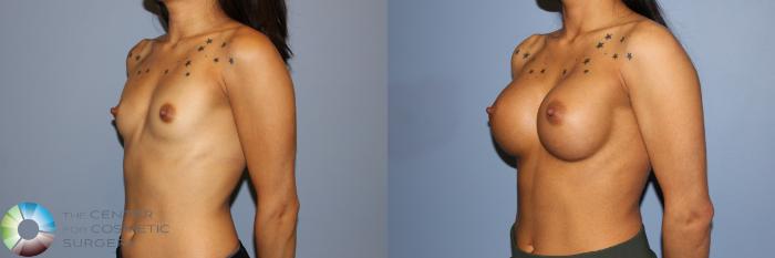Before & After Breast Augmentation Case 11238 Left Oblique View in Golden, CO