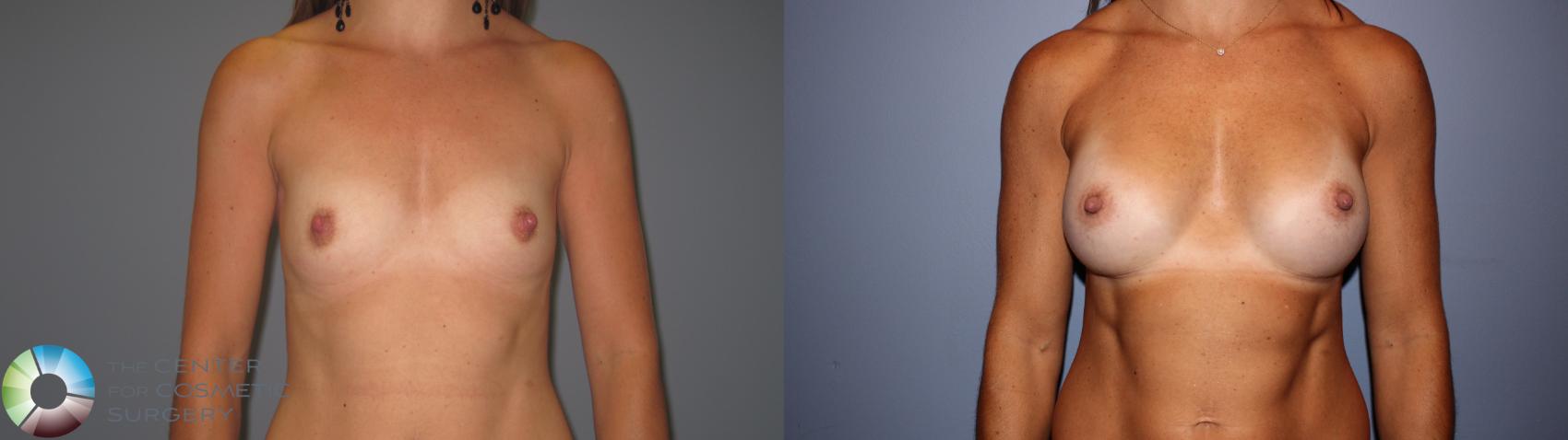 Before & After Breast Augmentation Case 11239 Front View in Golden, CO