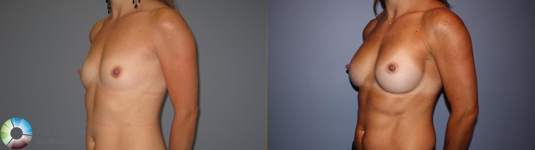 Before & After Breast Augmentation Case 11239 Left Oblique in Denver and Colorado Springs, CO