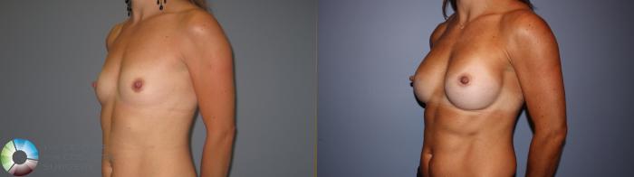 Before & After Breast Augmentation Case 11239 Left Oblique View in Golden, CO