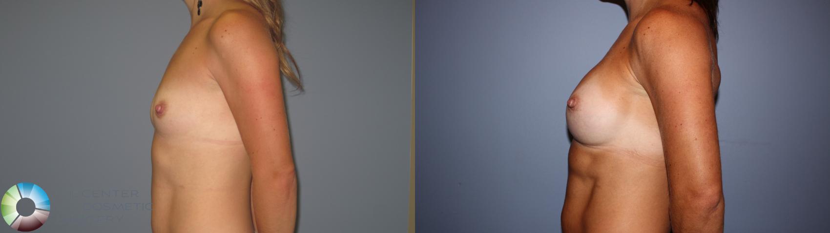 Before & After Breast Augmentation Case 11239 Left Side in Denver and Colorado Springs, CO