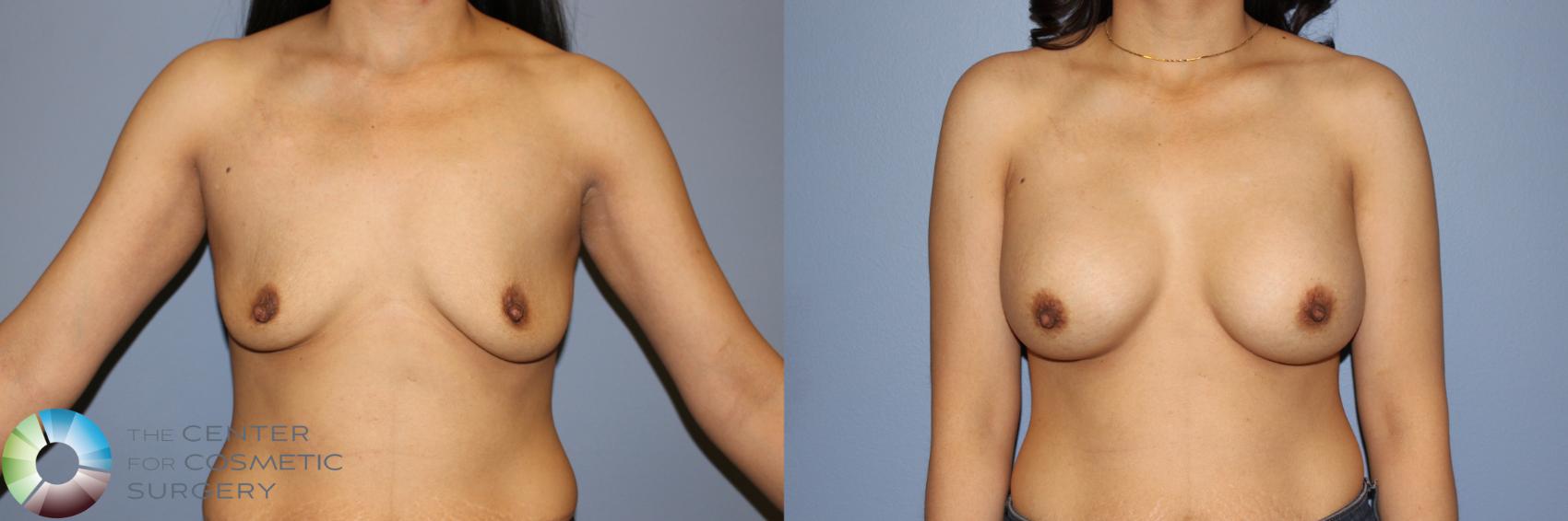 Before & After Breast Augmentation Case 11242 Front View in Golden, CO