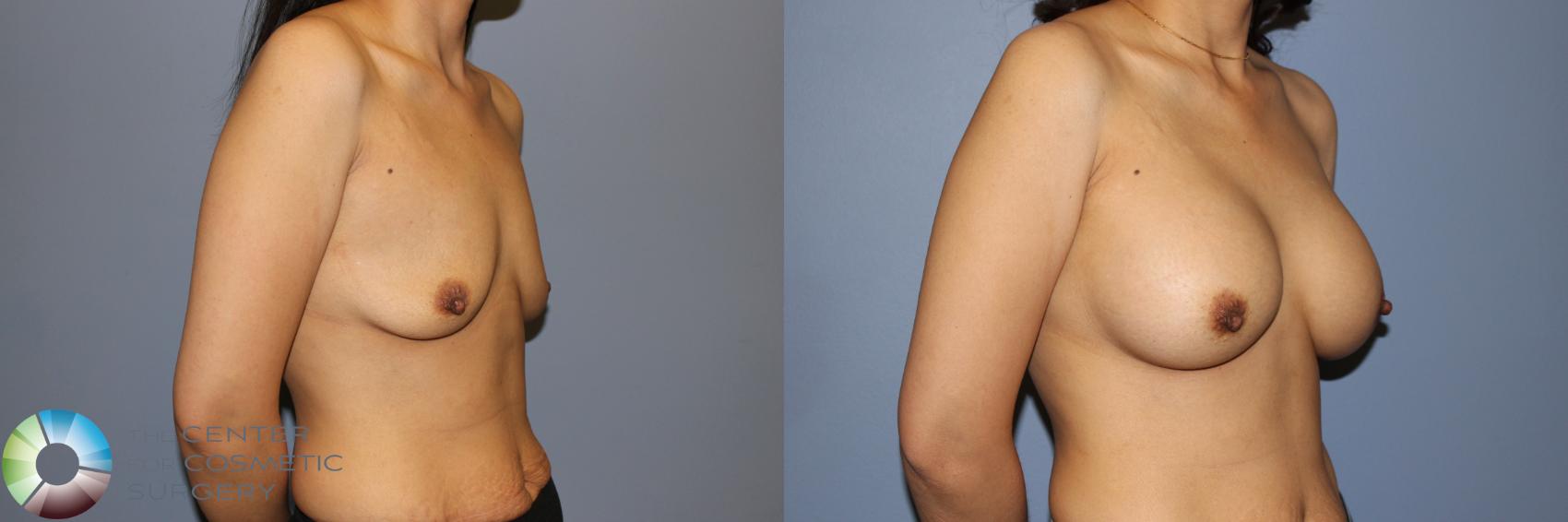Before & After Breast Augmentation Case 11242 Right Oblique in Denver and Colorado Springs, CO