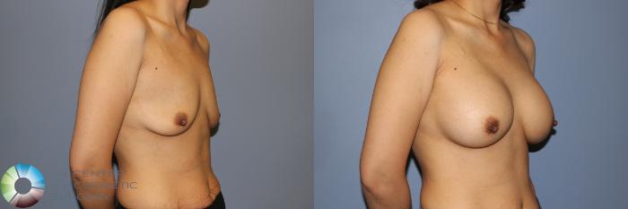 Before & After Breast Augmentation Case 11242 Right Oblique View in Golden, CO