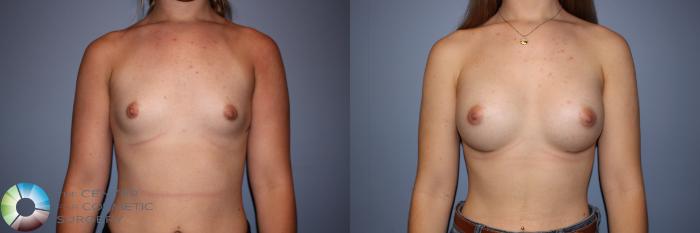 Before & After Breast Augmentation Case 11243 Front in Denver and Colorado Springs, CO