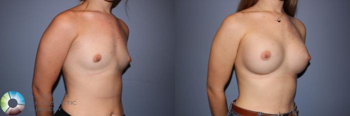 Before & After Breast Augmentation Case 11243 Right Oblique in Denver and Colorado Springs, CO