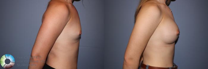 Before & After Breast Augmentation Case 11243 Right Side in Denver and Colorado Springs, CO