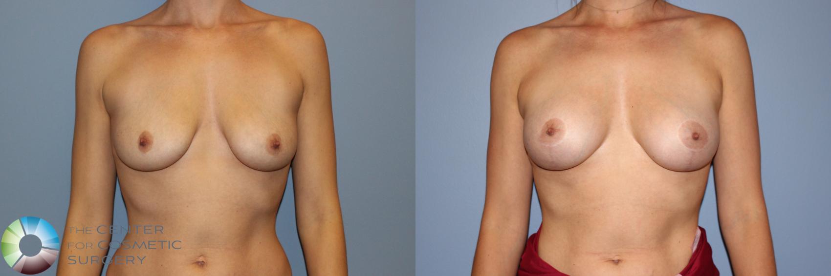 Before & After Breast Augmentation Case 11245 Front View in Golden, CO