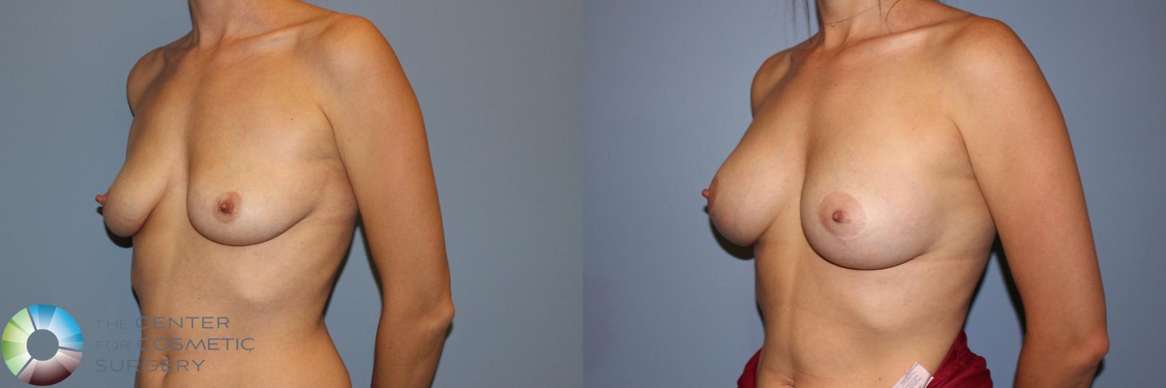 Before & After Breast Augmentation Case 11245 Left Oblique View in Golden, CO