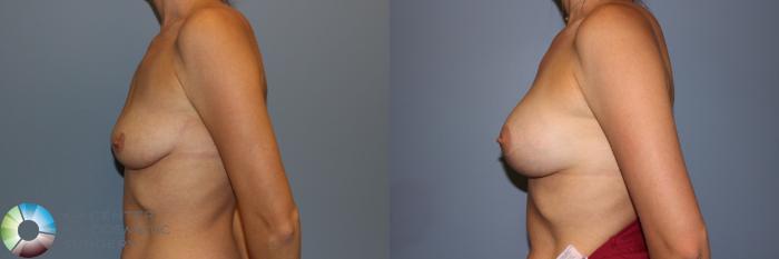 Before & After Breast Augmentation Case 11245 Left Side View in Golden, CO