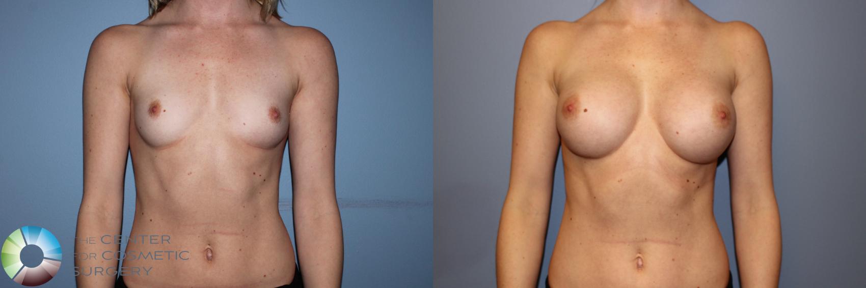 Before & After Breast Augmentation Case 11247 Front in Denver and Colorado Springs, CO