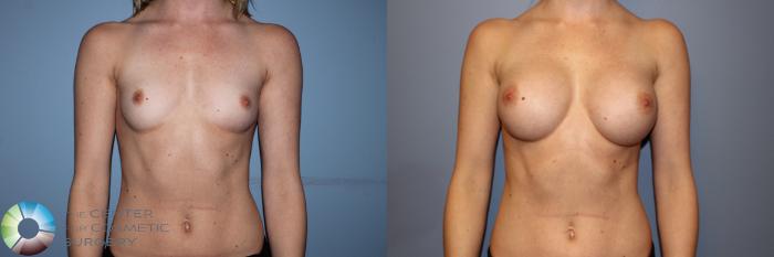 Before & After Breast Augmentation Case 11247 Front in Denver and Colorado Springs, CO
