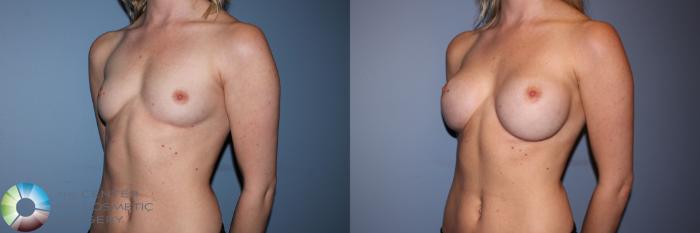 Before & After Breast Augmentation Case 11247 Left Oblique in Denver and Colorado Springs, CO