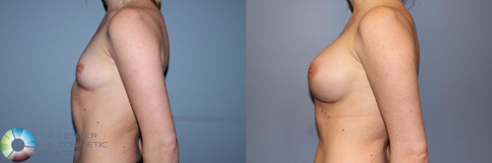 Before & After Breast Augmentation Case 11247 Left Side in Denver and Colorado Springs, CO
