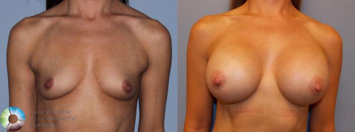 Before & After Breast Augmentation Case 11249 Front in Denver and Colorado Springs, CO