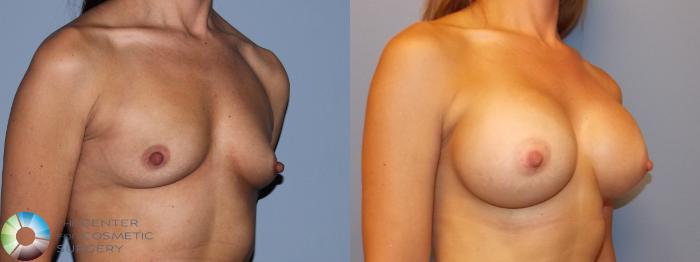 Before & After Breast Augmentation Case 11249 Right Oblique in Denver and Colorado Springs, CO