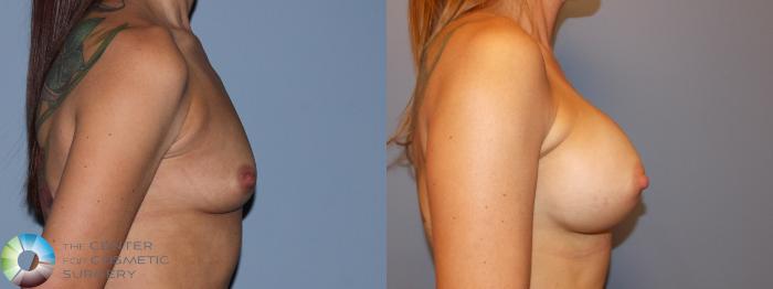 Before & After Breast Augmentation Case 11249 Right Side in Denver and Colorado Springs, CO