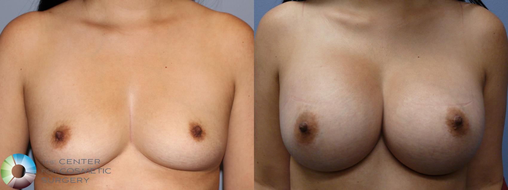 Before & After Breast Augmentation Case 11250 Front in Denver and Colorado Springs, CO