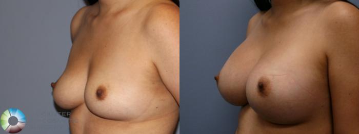 Before & After Breast Augmentation Case 11250 Left Oblique in Denver and Colorado Springs, CO