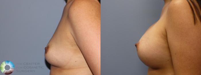 Before & After Breast Augmentation Case 11250 Left Side in Denver and Colorado Springs, CO