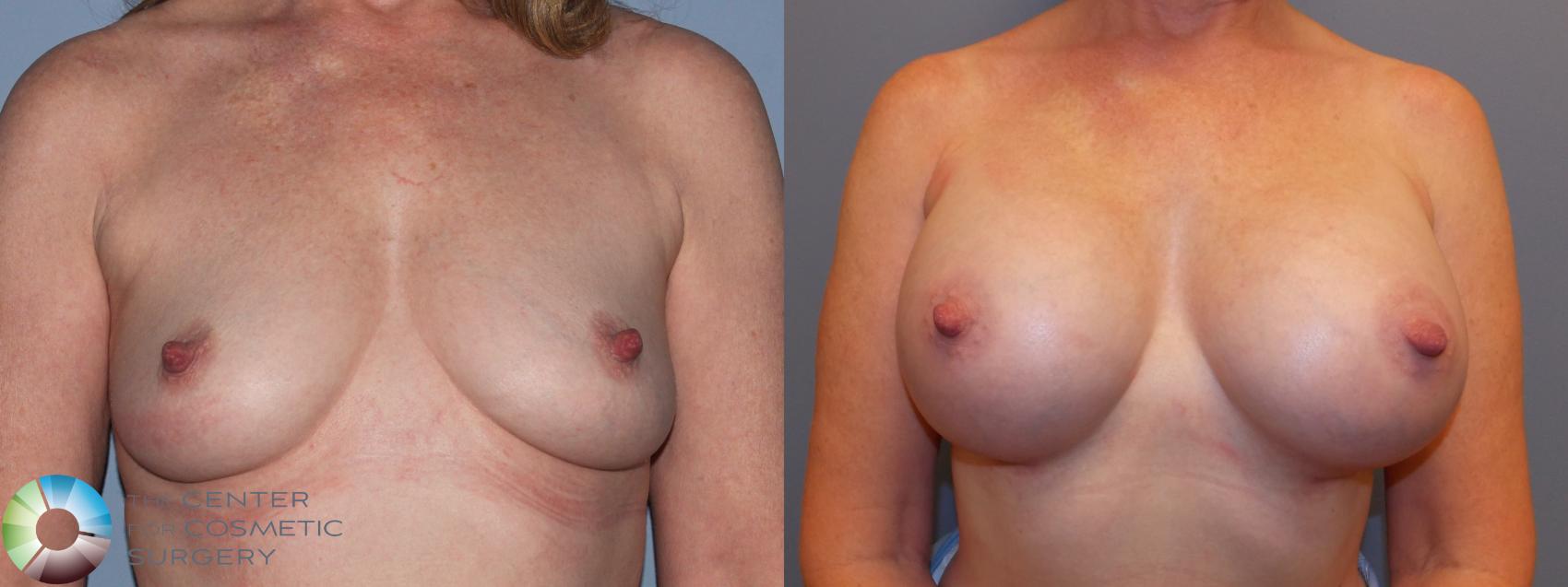 Before & After Breast Augmentation Case 11251 Front in Denver and Colorado Springs, CO