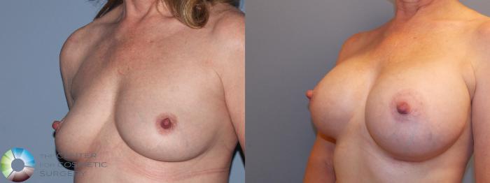 Denver Breast Augmentation