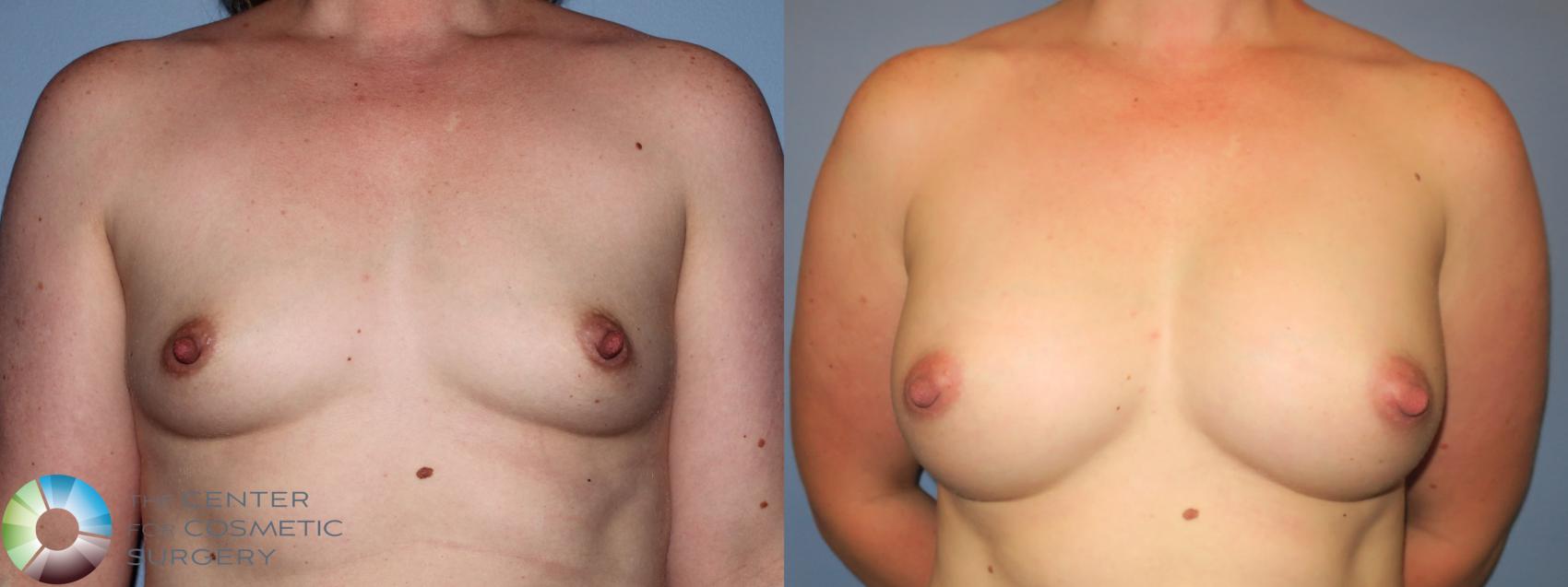 Before & After Breast Augmentation Case 11252 Front in Denver and Colorado Springs, CO