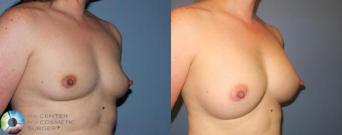 Before & After Breast Augmentation Case 11252 Right Oblique View in Golden, CO