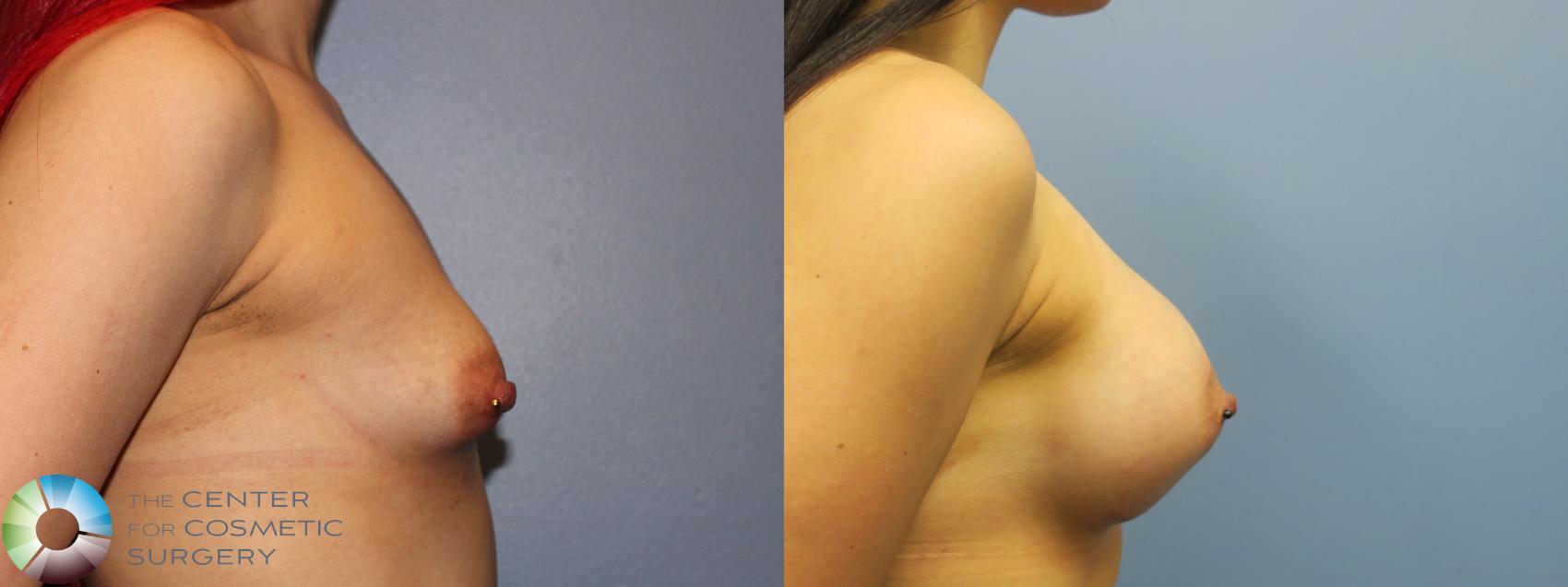 Denver Breast Augmentation
