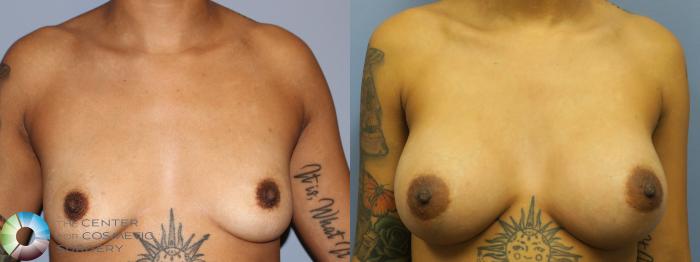 Before & After Breast Augmentation Case 11254 Front View in Golden, CO