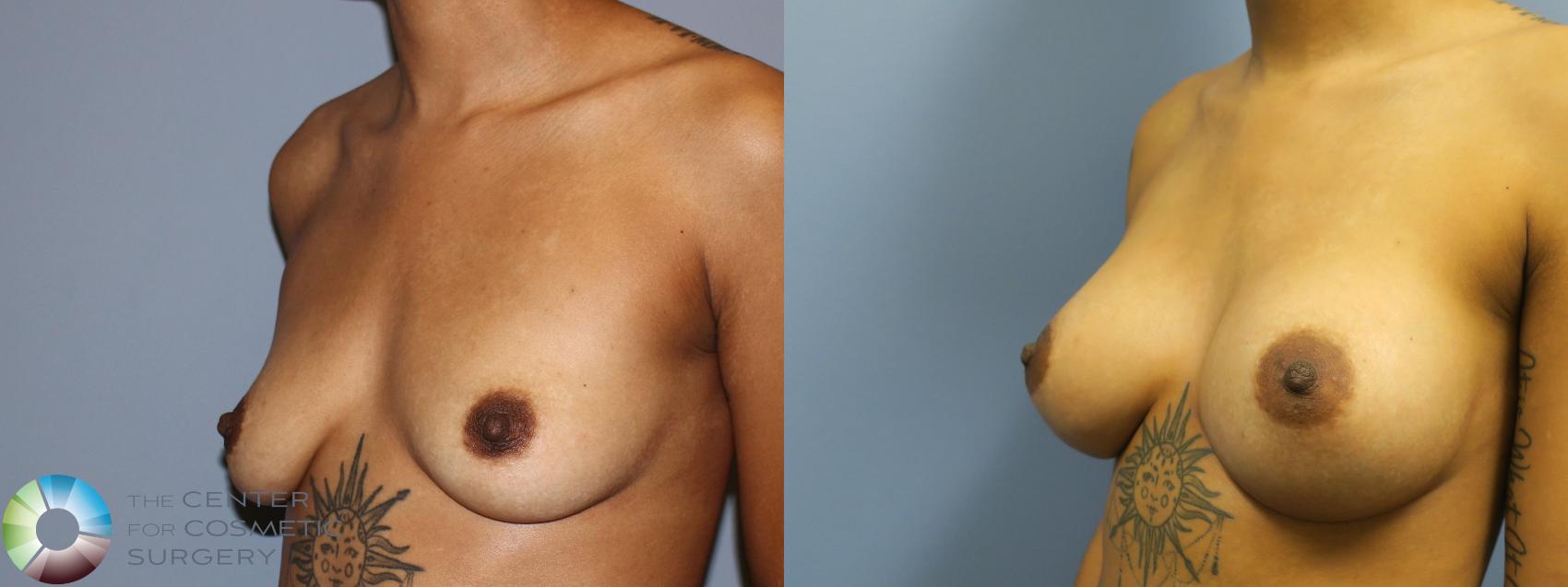 Before & After Breast Augmentation Case 11254 Left Oblique in Denver and Colorado Springs, CO