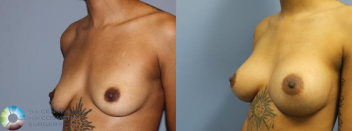 Before & After Breast Augmentation Case 11254 Left Oblique View in Golden, CO