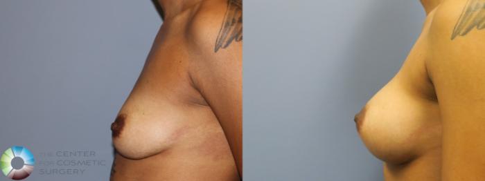 Before & After Breast Augmentation Case 11254 Left Side View in Golden, CO