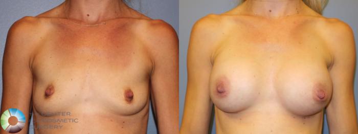 Before & After Breast Augmentation Case 11258 Front View in Golden, CO