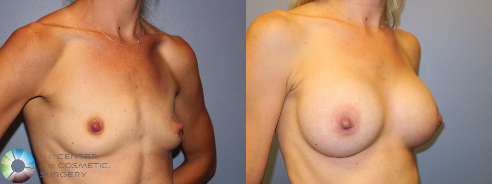 Before & After Breast Augmentation Case 11258 Right Oblique View in Golden, CO