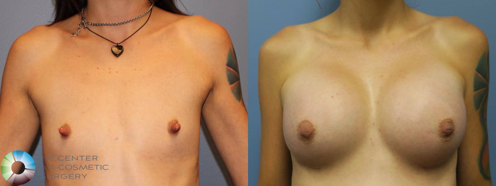 Before & After Nipple reduction Case 11259 Front in Denver and Colorado Springs, CO